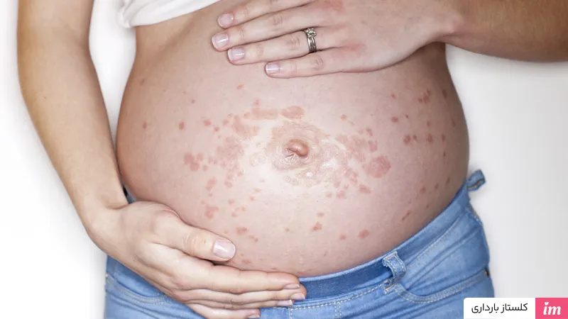 عکس کلستاز بارداری