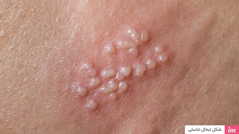 عکس تبخال تناسلی