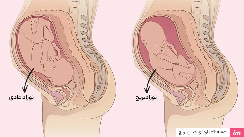 هفته 36 بارداری جنین بریچ