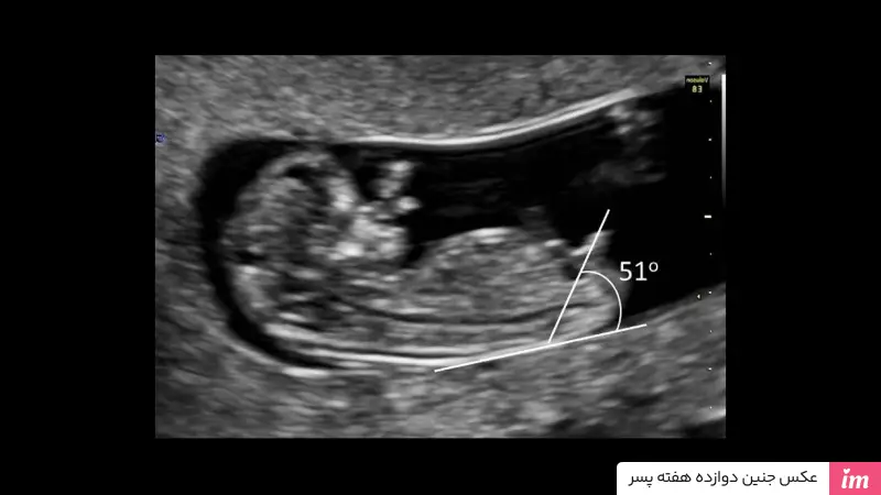 عکس جنین دوازده هفته پسر
