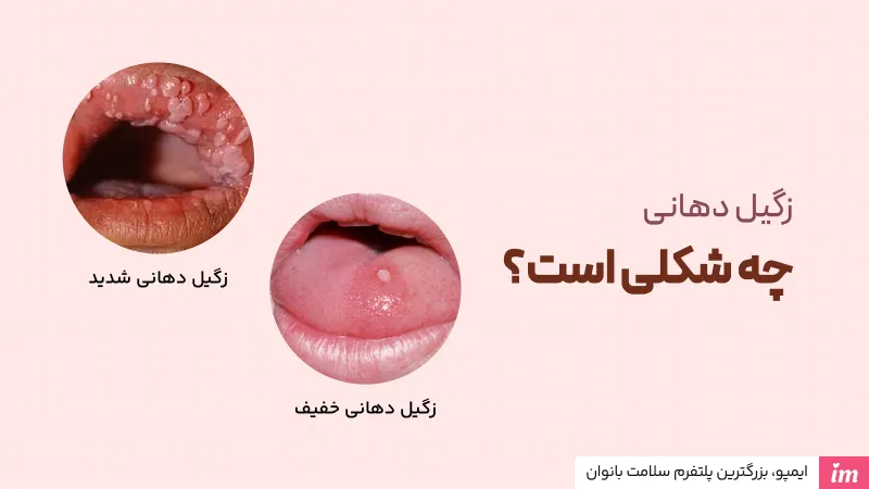عکس زگیل دهانی خفیف و شدید