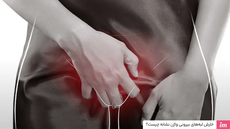 خارش لبه‌‌های بیرونی واژن نشانه چیست