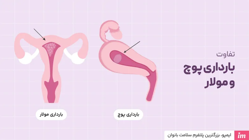 تفاوت علائم بارداری پوچ و حاملگی مولار