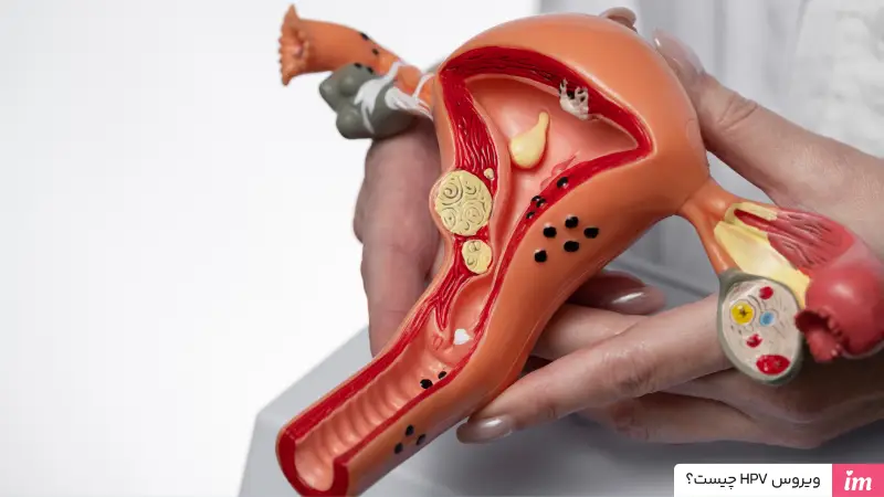 ویروس اچ پی وی چیست؟