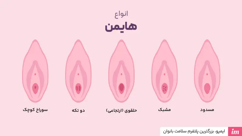 انواع پرده بکارت چیست