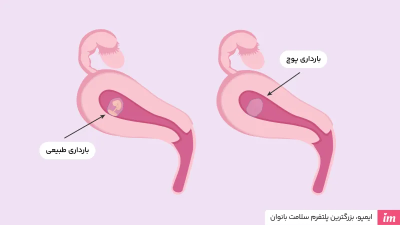 حاملگی پوچ چیست؟