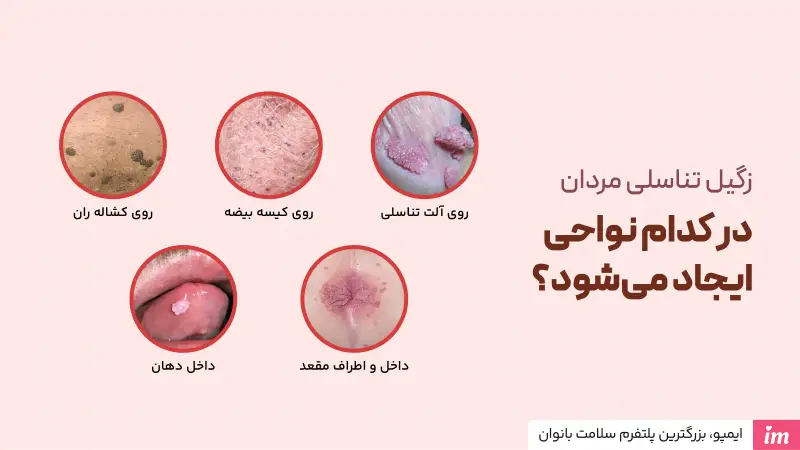 عکس زگیل تناسلی در مردان