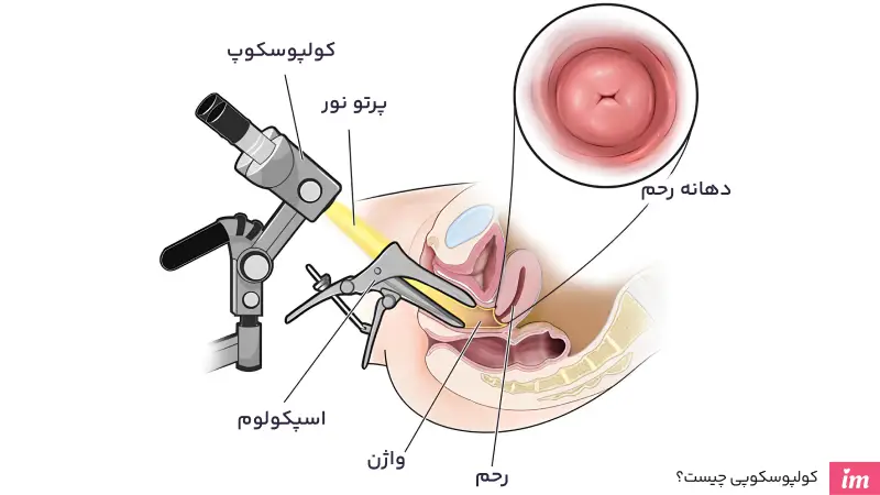 کولپوسکوپی چیست؟
