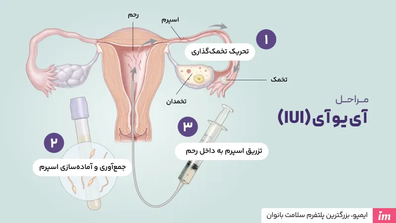 مراحل آی یو آی چیست؟