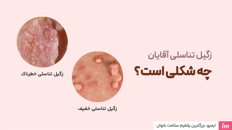 مقایسه عکس زگیل تناسلی در مردان خفیف و خطرناک