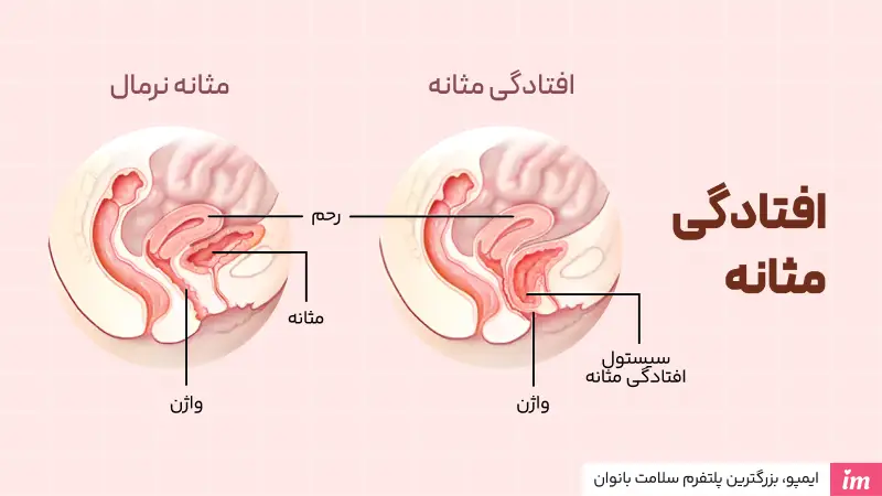 افتادگی مثانه