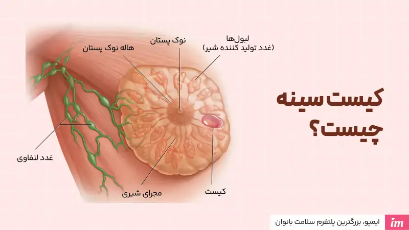 کیست سینه چیست؟