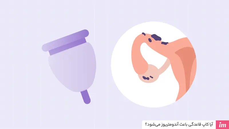 آیا کاپ قاعدگی باعث آندومتریوز میشود؟