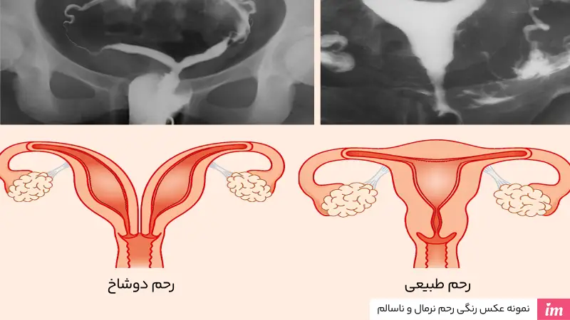نمونه عکس رنگی رحم نرمال و غیرنرمال