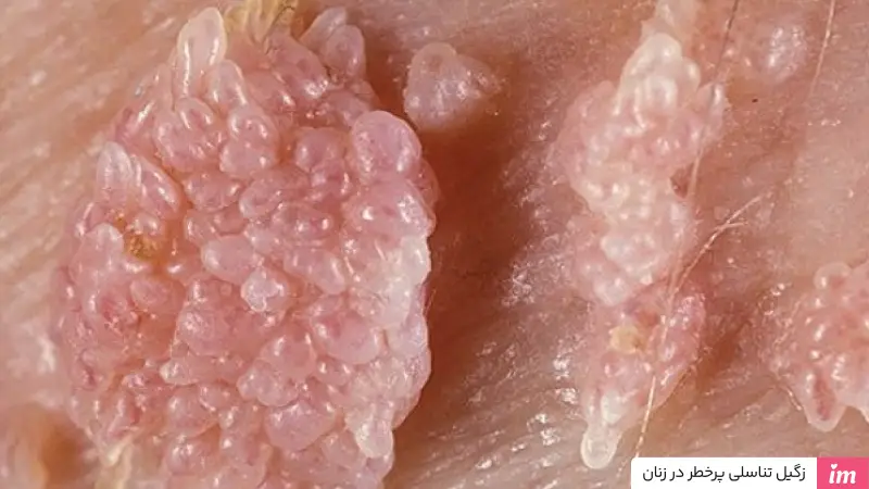 عکس زگیل تناسلی پرخطر در زنان