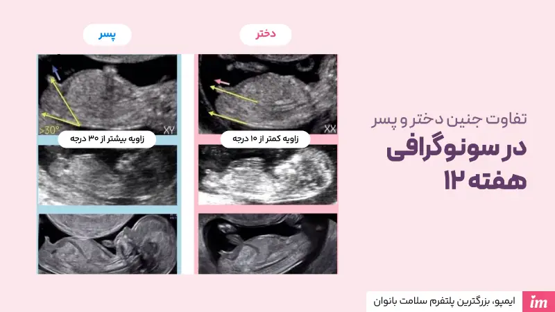 تفاوت جنین دختر و پسر در سونوگرافی هفته 12