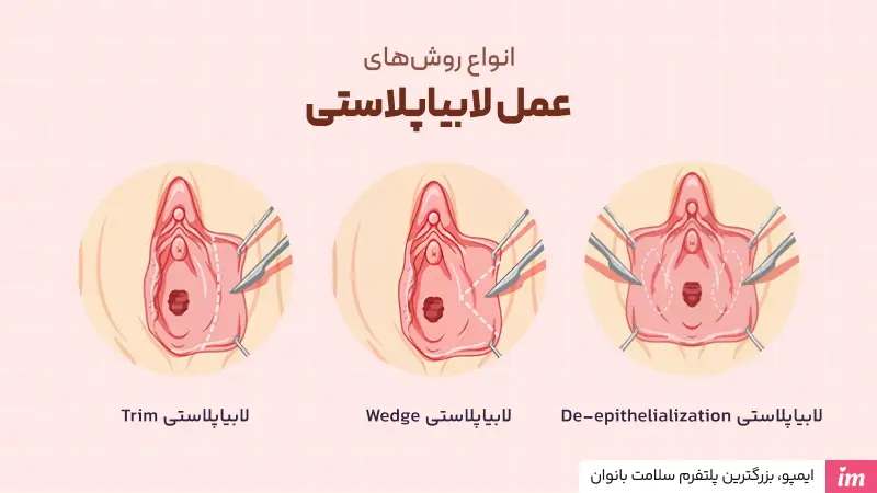 انواع روشهای لابیاپلاستی