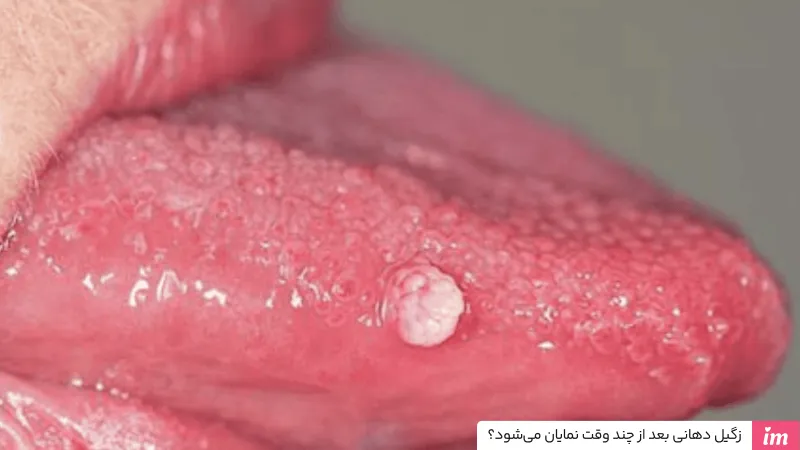 زگیل دهانی بعد از چند وقت نمایان می‌شود؟