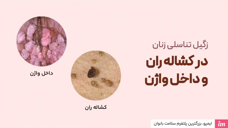 عکس زگیل تناسلی در داخل واژن و کشاله ران در زنان