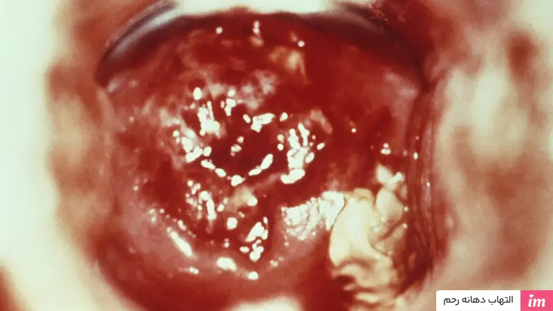 عکس التهاب دهانه رحم