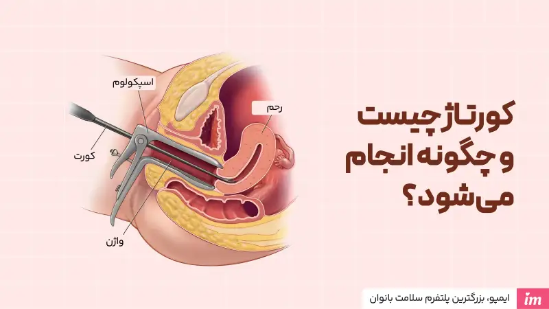 کورتاژ چیست و چگونه انجام می‌شود؟
