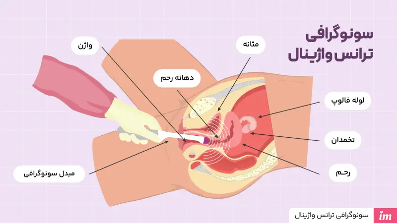 سونوگرافی واژینال چیست؟