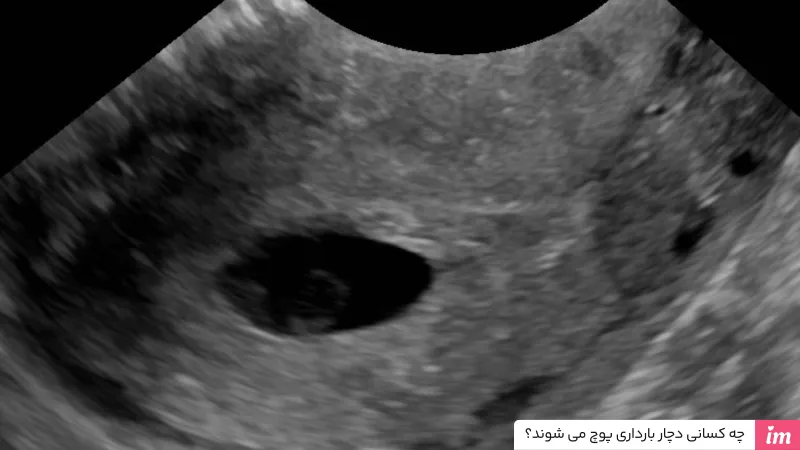 چه کسانی دچار بارداری پوچ می‌شوند