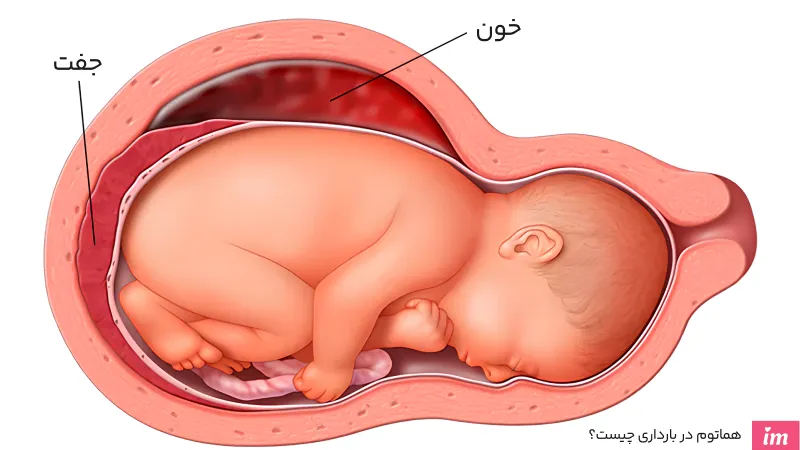 عکس هماتوم در بارداری
