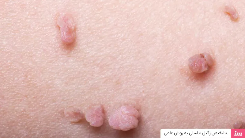 تشخیص زگیل تناسلی با روش علمی