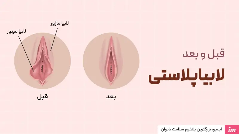 عکس قبل و بعد عمل لابیاپلاستی