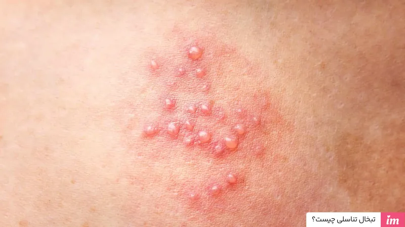 تبخال تناسلی چیست