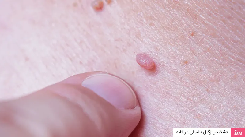 تشخیص زگیل تناسلی در خانه
