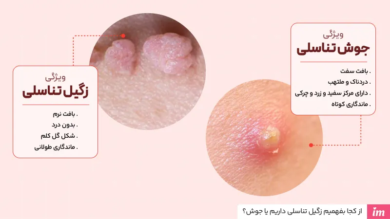 از کجا بفهمیم زگیل تناسلی داریم یا جوش؟