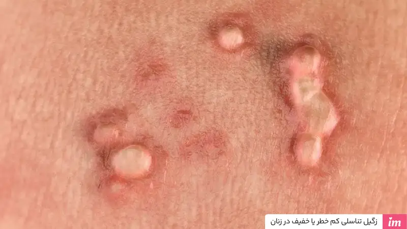 عکس زگیل تناسلی کم خطر در زنان