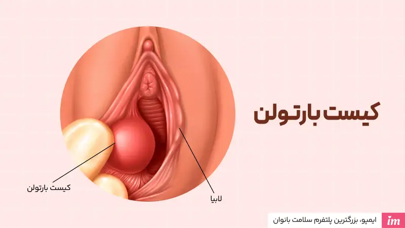 عکس واقعی کیست بارتولن